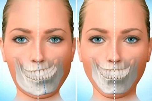 Ilustração de dois rostos femininos iguais, um com arcada dentaria deslocada a direita e outra com arcada dentária centralizada.