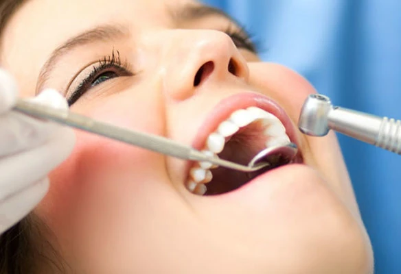 Foto de uma mulher branca com a boca aberta fazendo limpeza nos dentes.