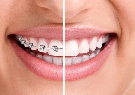 Foto da boca de mulher branca com metade dos dentes com aparelho odontológico e a outra metade sem aparelho.